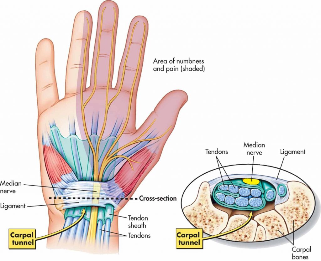 Carplaal Tunnel Syndroom | Motion Fysiotherapie En Preventie